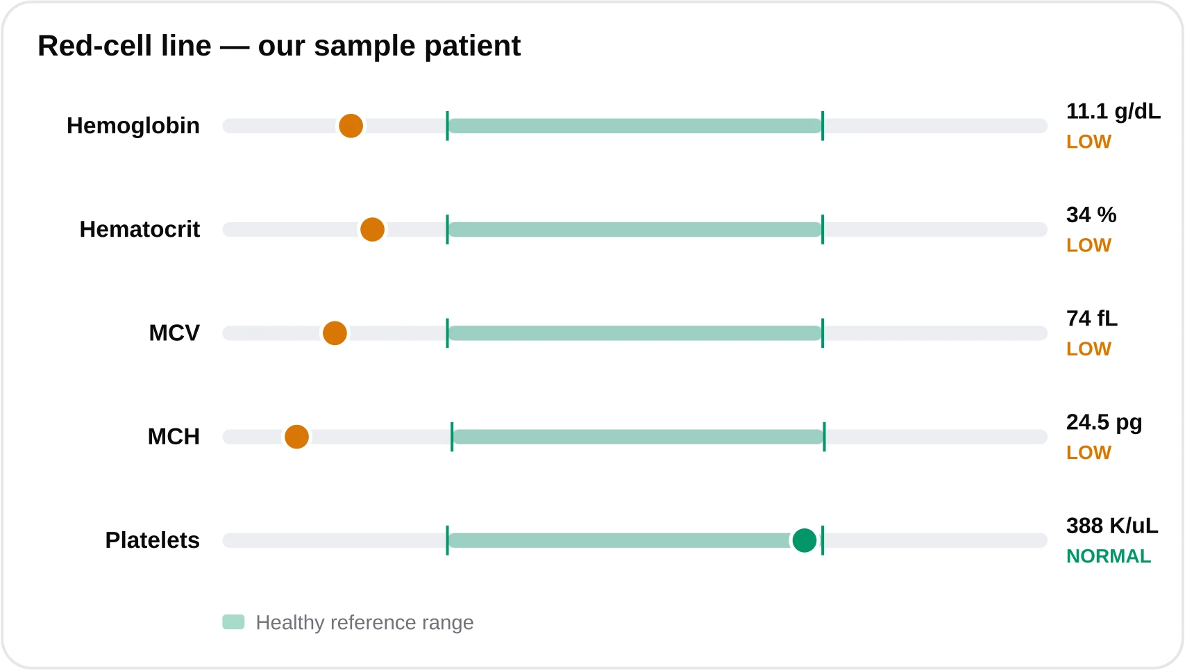 Range band chart showing hemoglobin 11.1 g/dL below the 12 to 15.5 range, MCV 74 fL below the 80 to 100 range, and MCH low, indicating a microcytic anemia